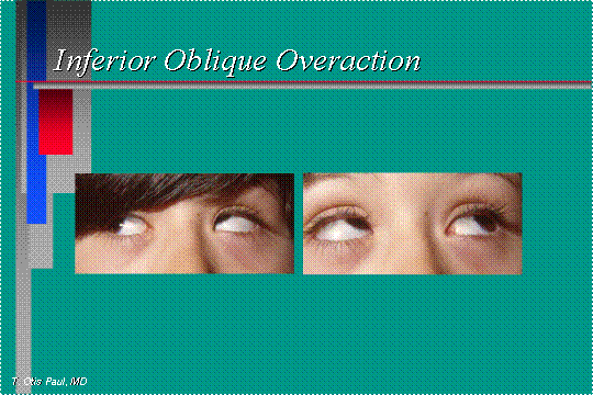 Inferior oblique overaction