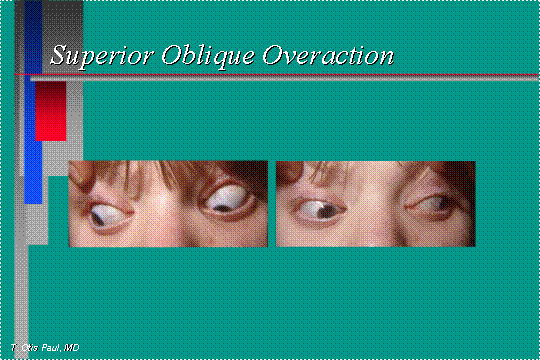 Superior oblique overaction 