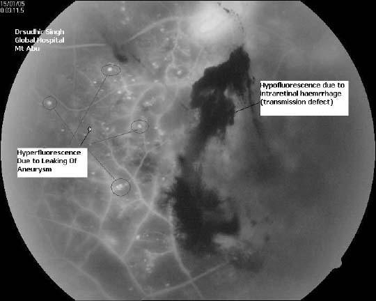 Hyper-fluorescence and Hypo-fluorescence (courtsey: Dr Sudhir Singh)