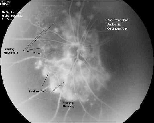 Dye leaking neo vascularization and aneurysms,Venous beading(Courtsey: Dr Sudhir Singh)