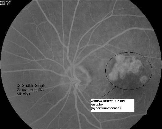 Window defect due to RPE atrophy (Courtsey: Dr Sudhir Singh)