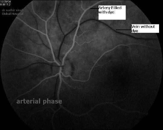 Arterial phase FFA,Courtesy: Dr Sudhir Singh