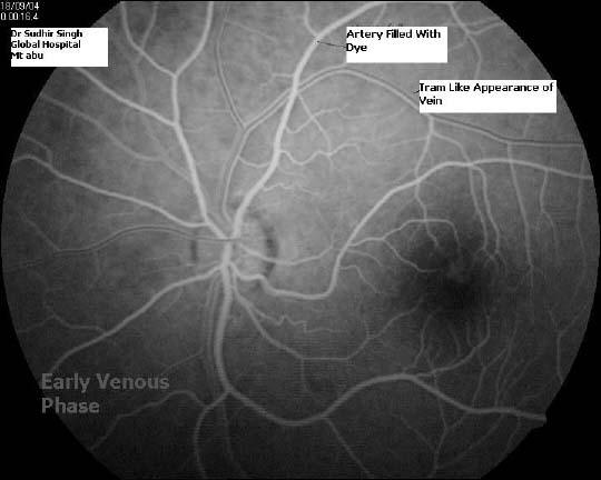 Early Venous  phase FFA,Courtesy: Dr Sudhir Singh