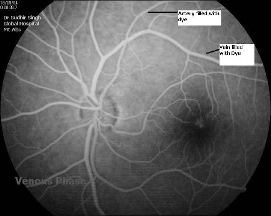  Venous  phase FFA,Courtesy: Dr Sudhir Singh