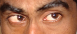 Esotropia  in up gaze ( Pic. Curtsey Dr Sudhir Singh) 