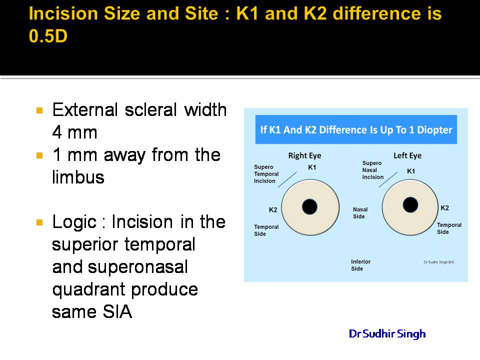 Incision in MSICS