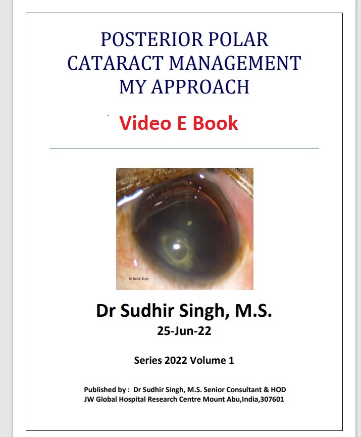 Posterior Polar Cataract 